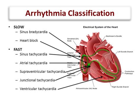 arrhythmia definition medical terms